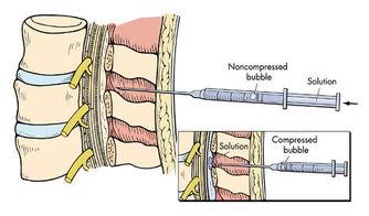 骶管麻醉的视频,骶管麻醉操作步骤及要点解析